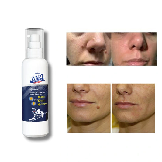 WART REMOVER - Crema removedora de verrugas hecha de ingredientes naturales